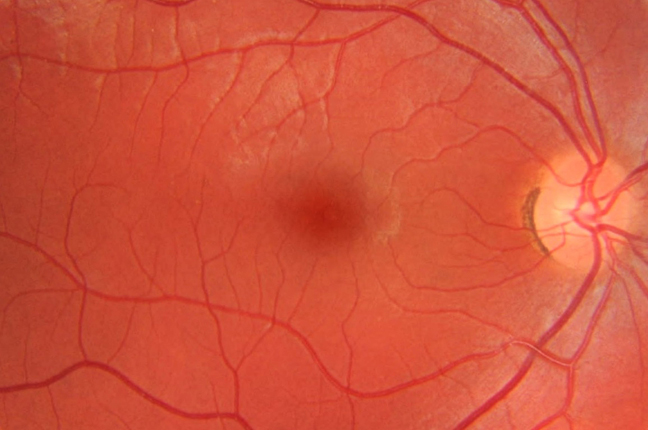Il risultato grafico della retinografia: la fotografia del fondo oculare permette di individuare la presenza di degenerazioni o anomalie al suo interno