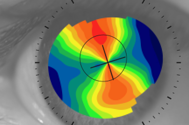 Il risultato grafico della topografia: la “mappa corneale”, o mappa cromatica, ottenuta sull'occhio di un cliente di Ottica Galuzzi